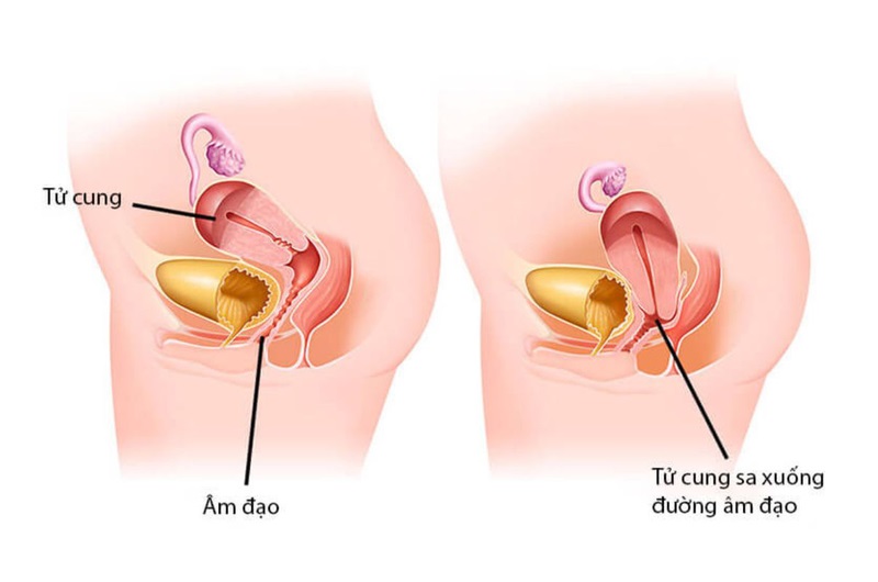 Sa sinh dục là tình trạng mà tử cung của phụ nữ bị tụt xuống