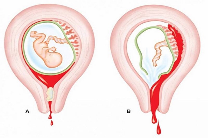 Khả năng có con lại sau khi phá thai một lần