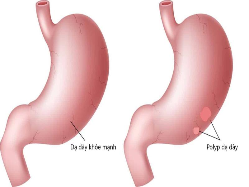 Sự khác biệt giữa dạ dày khỏe mạnh và polyp dạ dày