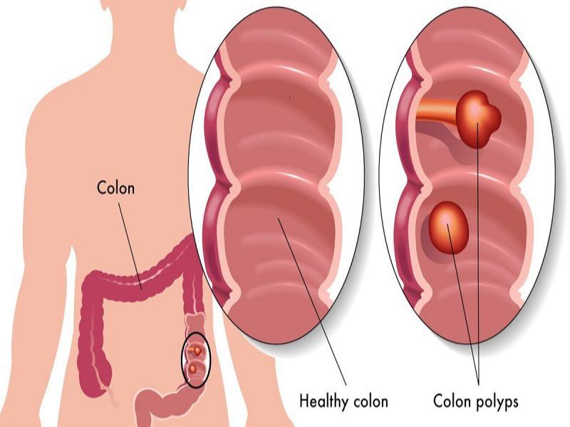 Polyp đại tràng không cuống và polyp đại tràng có cuống