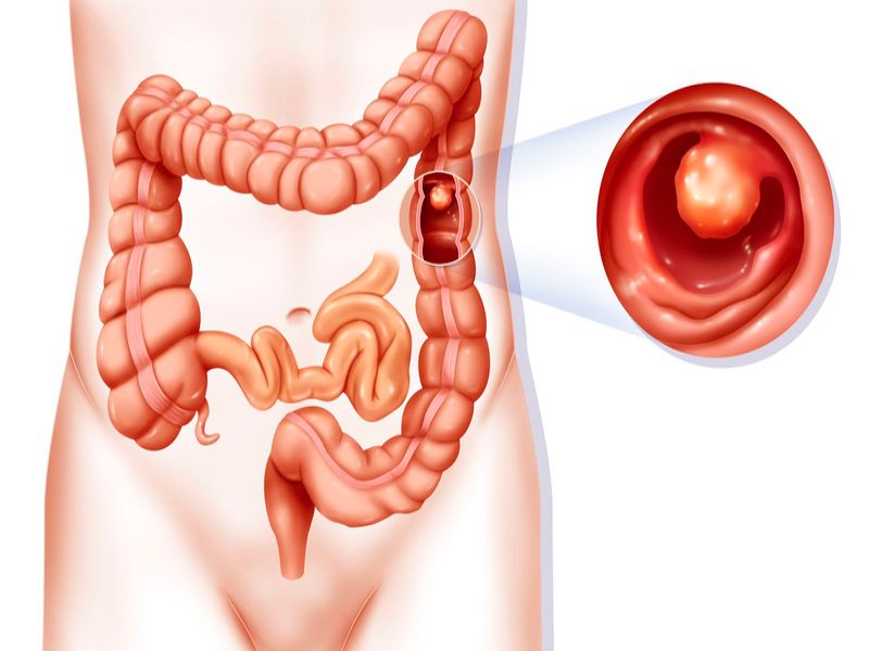 Polyp đại tràng là gì?