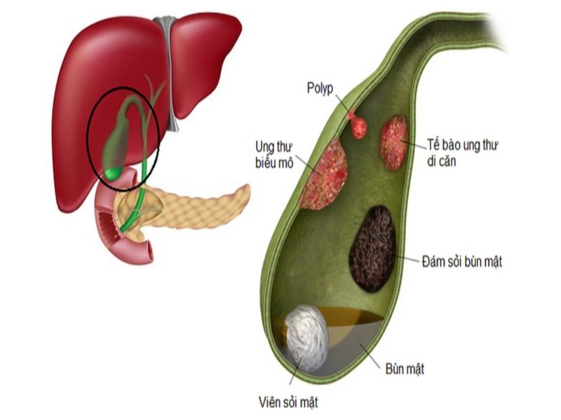 Polyp túi mật là những u nhú hình thành trên bề mặt niêm mạc của túi mật