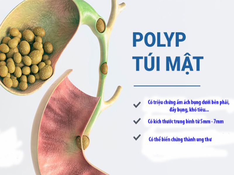 Polyp túi mật là gây ra do sự phát triển không bình thường của mô