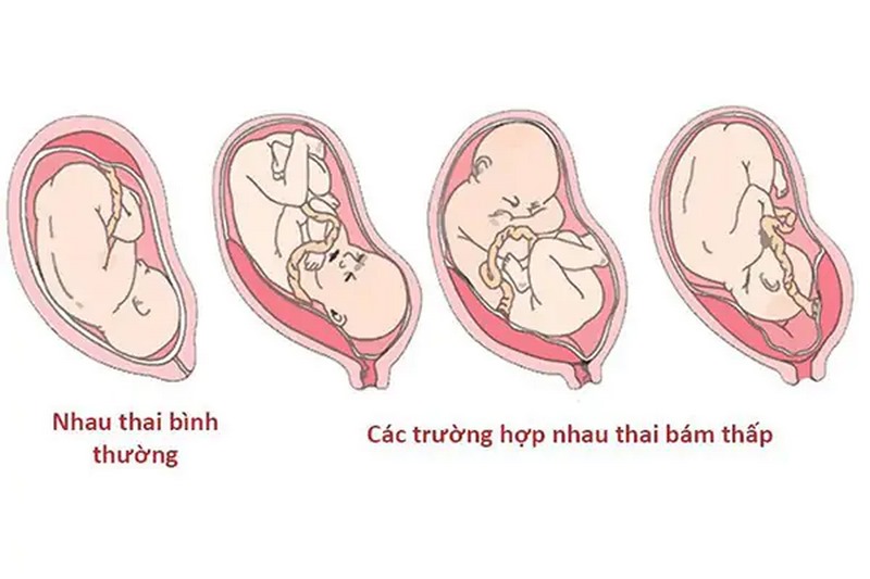 Nhau thai bám thấp có sinh thường được không?