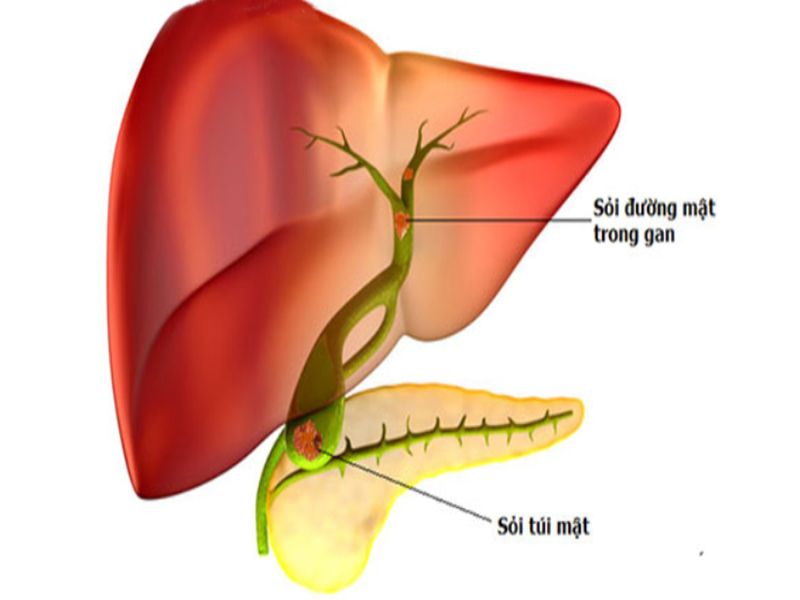 Sỏi đường mật trong gan thường tạo thành trong các đường dẫn mật bên trong gan