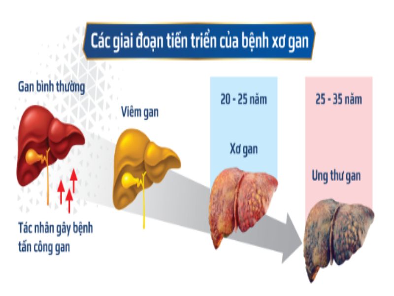 Các giai đoạn tiến triển của bệnh xơ gan