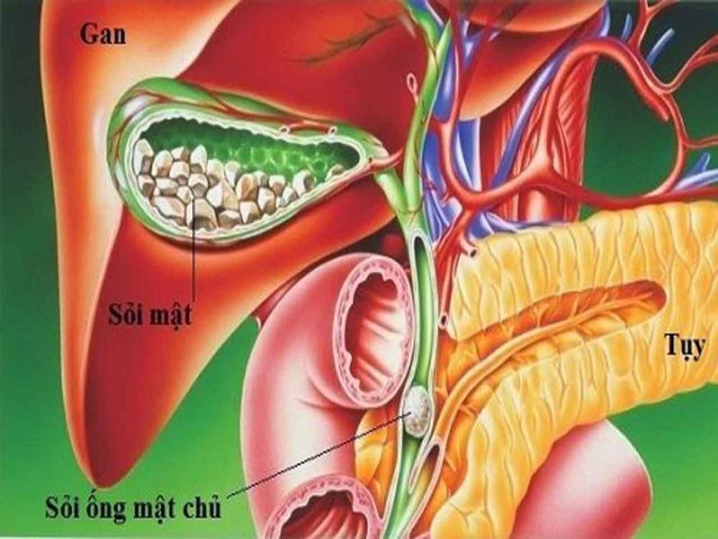 Nồng độ cholesterol càng cao, nguy cơ hình thành sỏi càng tăng.