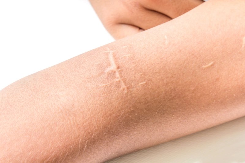 Sẹo lồi nên sử dụng Hiruscar trắng