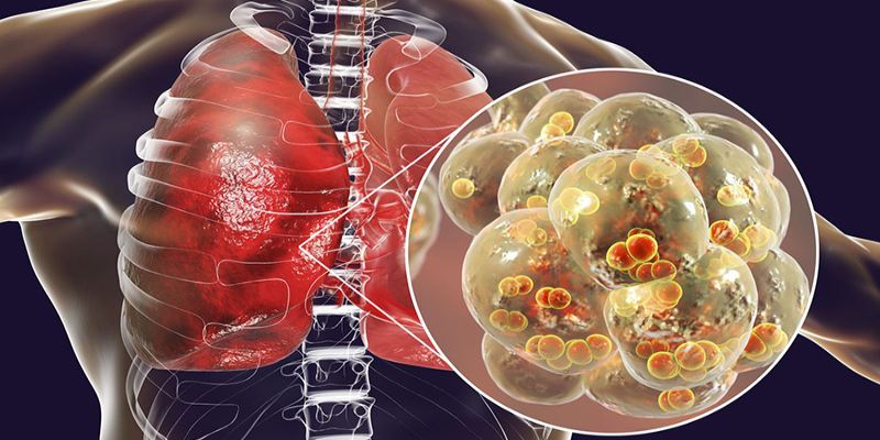 Tiểu đường biến chứng qua phổi gây viêm phổi