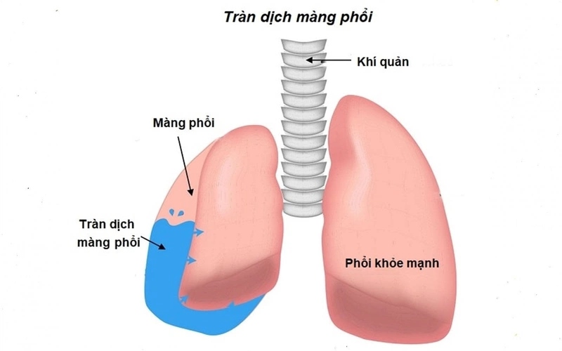 Tràn dịch màng phổi có thể do nhiều nguyên nhân khác nhau