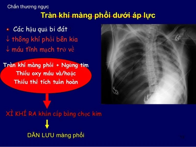 Tràn khí màng phổi áp lực có thể do nhiều nguyên nhân khác nhau