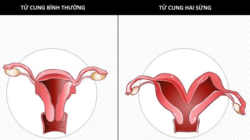 Tử cung hai sừng là một dạng dị tật bẩm sinh của tử cung