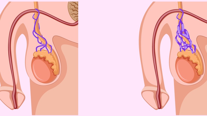 Nguyên nhân giãn tĩnh mạch thừng tinh