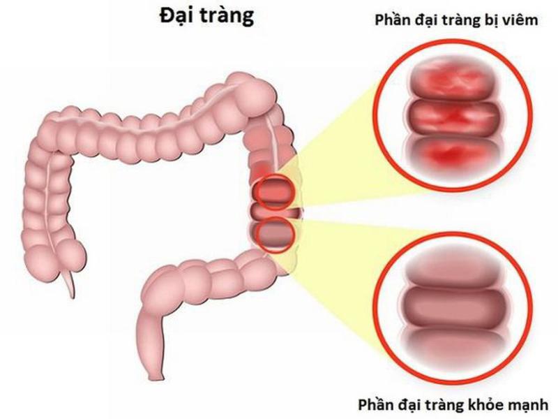 Viêm đại tràng có thể xuất phát từ nhiều nguyên nhân khác nhau