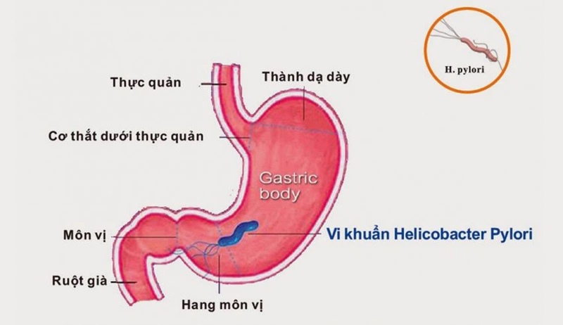 Nhiễm khuẩn Helicobacter pylori là nguyên nhân phổ biến nhất