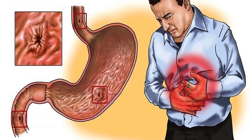 Nhiễm khuẩn H. pylori kéo dài có thể làm tăng nguy cơ phát triển ung thư dạ dày.