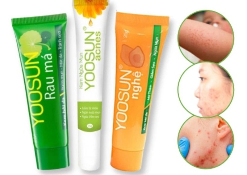 Các loại kem trị mụn của Yoosun