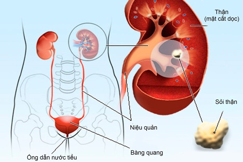 Tiểu đường có thể gây tổn thương thận