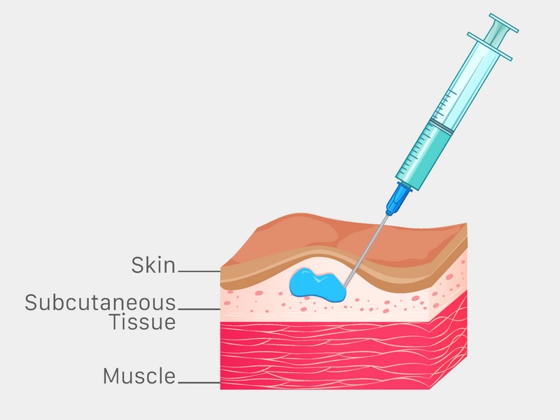 Tiêm dưới da là gì?