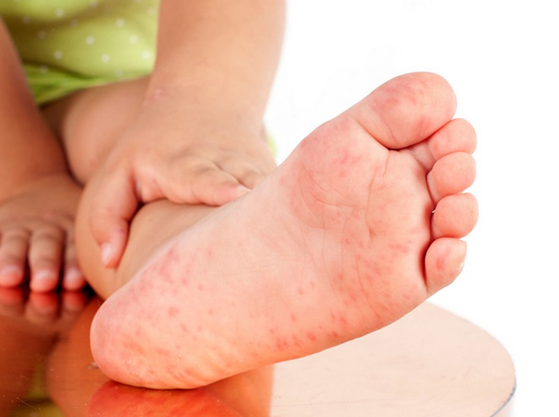 Nguyên nhân gây ngứa lòng bàn tay bàn chân